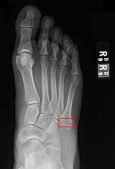 broken_foot
